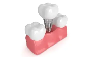 Single Dental Implant