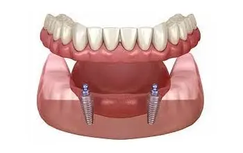 Snap In Denture