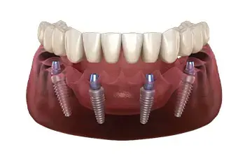 All On X Dental Implants