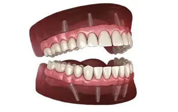 Zirconia Fixed Teeth