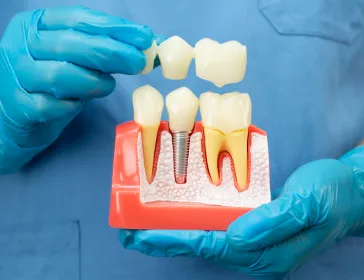 Benefits of All-on-4 dental implants