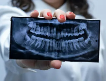 All-on-4 vs Traditional Implants comparison