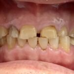 All-Decayed-Teeth-Missing-Teeth3