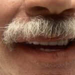 All-Decayed-Teeth-Missing-Teeth5