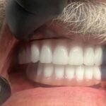 All-Decayed-Teeth-Missing-Teeth6