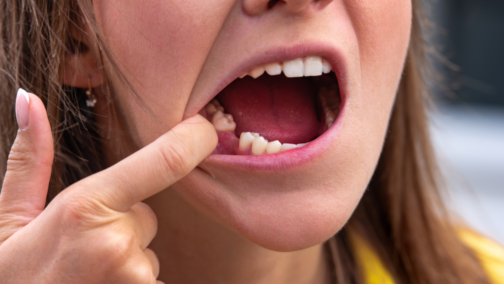 Emergency Tooth Replacement in Arlington & Mansfield, TX | Same-Day