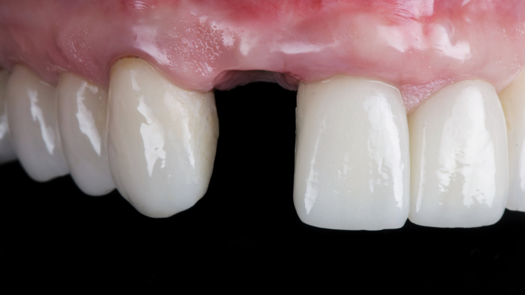 Replacing a Single Missing Tooth in Irving, TX: Cost & Process (2026)