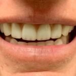 after-snap-on-dentures-irving-tx-dentist