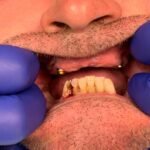 full-teeth-after-sho4