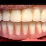 full-teeth-after-shot3