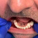 full-teeth-after-shot6