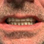 full-teeth-after-shot7