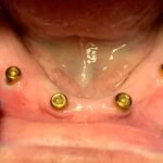 lower-dental-implants-during-procedure