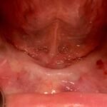 no-lower-teeth-before