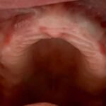 no-upper-teeth-before