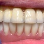 patient-mouth-rehab-implants-2
