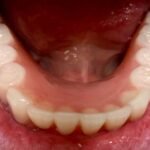 patient-mouth-rehab-implants-3