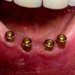 patient-mouth-rehab-implants-4