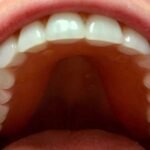 snap-on-dentures-after-top-teeth