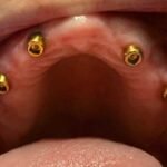 upper-dental-implants-during-procedure
