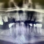 x-ray-prior-to-upper-lower-mouth-reconstruction1