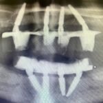 x-ray-prior-to-upper-lower-mouth-reconstruction2