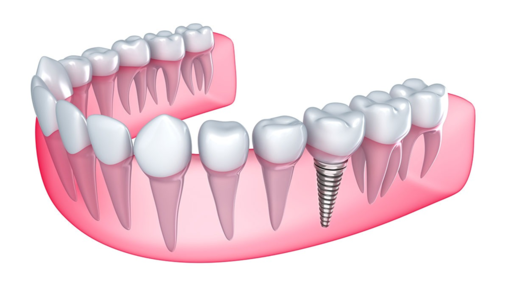 Dental Implants in DFW, TX A Complete Guide to Cost, Procedure, and Recovery